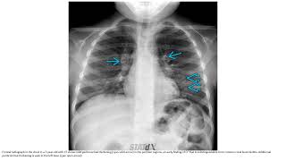 Cystic Fibrosis Pulmonary Imaging [upl. by Yhtrod]