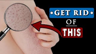 How to GET RID of WHITE BUMPS on ARMS  KERATOSIS PILARIS [upl. by Anderea]