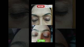 XANTHELASMA WHAT IT IS amp HOW IT IS TREATED DR DRAY shorts ytshorts xanthelasma [upl. by Artema]