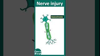 Types of nerve injury  neuropraxia  axonotmesis  neurotmesis  Wallerian degeneration  USMLE [upl. by Erehc]