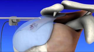 Shoulder Arthroscopy [upl. by Ina]