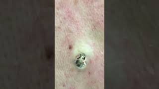 MASSIVE Blackhead Popped Out DrPimplePopperThisIsZit Shorts [upl. by Sarita]