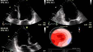 DOBUTAMINE STRESS ECHO MITRAL REGURGITATION  ECHOCARDIOGRAPHY cardiac ultrasound [upl. by Ikuy]