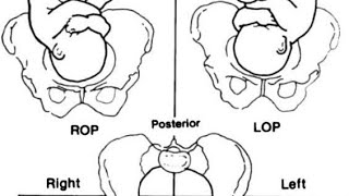 اسهل طريقة لتحديد malposition and malpresentation  مادة توليد obstetrics [upl. by Duffie57]