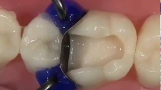 White Composite Filling a Molar  Rajan Dental [upl. by Lesde]