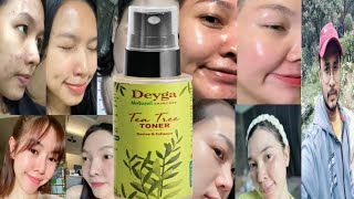 Deyga Tea Tree Toner  Honest Review [upl. by Noemad]