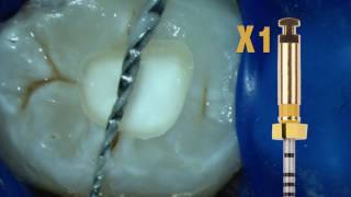 ProTaper Next™ Technique with Dr Scianamblo  Dentsply Sirona [upl. by Icaj]