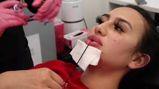 GETTING LIP INJECTION FILLER Keyhole Pout Technique with Juvederm Ultra XC at California Cosmetics [upl. by Ramsay]