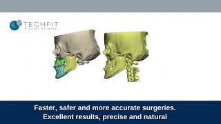 Orthognathic digital Planning solution  Techfit Digital Surgery [upl. by Thibault]