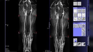 Periferik Anjio MR Nasıl Çekilir Abdominal Anjio Nasıl Çekilir Kanal Radyoloji MR Çekim Teknikleri [upl. by Andrews]