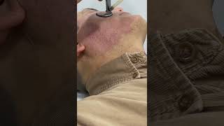 Erase Scars Fast with CO2 Fractional Laser Treatment shortvideo scarremoval [upl. by Melda]