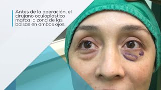 Blefaroplastia del párpado inferior cirugía para extraer bolsas debajo de los ojos [upl. by Nayek]