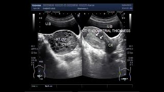 Endometrial Hyperplasia and Hemorrhagic Ovarian Cyst [upl. by Taffy]