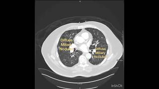 Miliary TB on CT Chest tuberculosis pulmonary pulmonology [upl. by Lecirg]