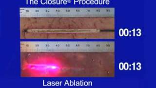 Tissue Thermal Ablation Pattern of ClosureFAST vs Laser [upl. by Keyte152]