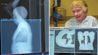 Radiation Therapy for Lung Cancer  Short Video [upl. by Erny]