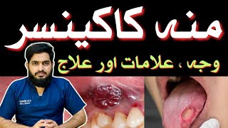 ORAL CANCER  Symptoms  Causes  Treatment  منہ کا کینسر  Urdu  Hindidrmuneermalik [upl. by Calloway755]