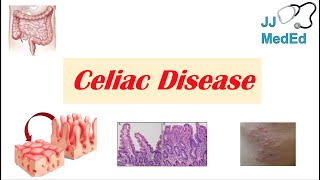 Celiac Disease amp Gluten Sensitivity Risk Factors Pathogenesis Symptoms Diagnosis Treatment [upl. by Akire]