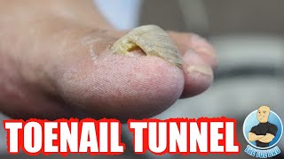 DAMAGED THICK TOENAIL HAS NOW GROWN INTO A TOENAIL TUNNEL [upl. by Kcerred294]