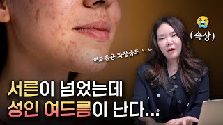 10년째 여드름 불치병 아닙니다 치료를 위해서 필요한건 [upl. by Gelman24]