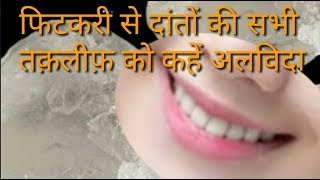 फिटकरी से दांतों की सभी तक़लीफ़ को कहें अलविदा  Tooth aching benefits of alum  Fitkari ke fayde [upl. by Eugenius912]