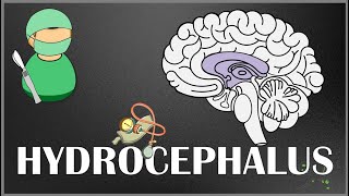 Hydrocephalus  Causes Types Signs and Symptoms Pathophysiology Diagnosis and Treatment [upl. by Okubo]