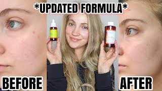 I Tried The Good Molecules Discoloration Correcting Serum For 5 Weeks NEW FORMULA [upl. by Anaujik]