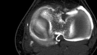 Kyste méniscal et Arthroscanner [upl. by Minica]