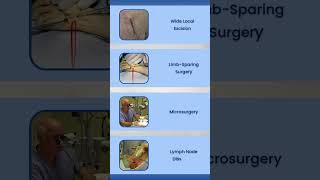 Liposarcoma Screening amp Treatment Options [upl. by Ahcrop38]