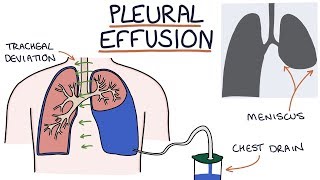 Understanding Pleural Effusions [upl. by Patience]