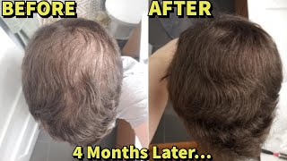 He Was Microneedling WITHOUT FinasterideMinoxidil For 4 MonthsSHOCKING Results [upl. by Ireg]