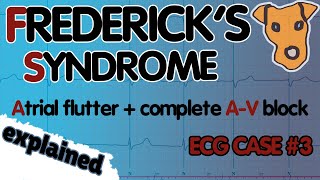 Typical ATRIAL FLUTTER with COMPLETE AV BLOCK Fredericks syndrome Electrophysiologic basics [upl. by Chill]