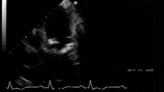 echocardiogram  cardiac calcification in chronic kidney failure with hyperparathyroidism [upl. by Hilbert]