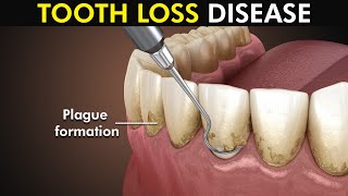 Periodontitis or Gum disease 3d animation included [upl. by Ramar264]