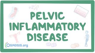 Pelvic inflammatory disease  causes symptoms diagnosis treatment pathology [upl. by Struve]