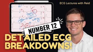 Improve your EKG Skills test yourself  ECG No 12 [upl. by Gherardo515]