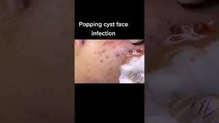 Cystic Acne Removal amp Inflammatory Acne [upl. by Oguh]