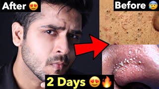 How to Remove Blackheads Whiteheads Naturally  Tips To Remove Whiteheads Blackheads From FACE [upl. by Doroteya]