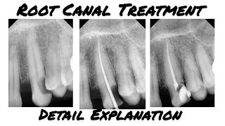 Root Canal Treatment on live Patient 23 Canine  Single Seating RCT  RCT [upl. by Anala897]