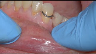 C esthetic anterior crown CFAO et appareil amovible partiel [upl. by Guyon]