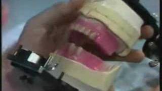 Mounting Anterior Teeth Part 4 [upl. by Fabozzi]