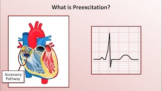 Advanced EKGs  WolffParkinsonWhite WPW Syndrome [upl. by Wolford930]