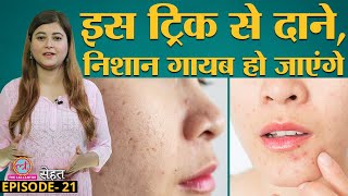 Acne Scars Pimples से कैसे छुटकारा पाएं खुद Doctors से सुने  Sehat Ep 21 [upl. by Carl]