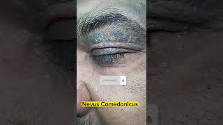 Comedo Nevus😱🔥  Nevus Comedonicus on upper eyelid in old patient dermatology comedone acne scar [upl. by Alleuqram192]