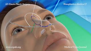 Rinoplastica elastica  Modellare il naso senza interventi chirurgici invasivi [upl. by Henebry]