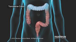 Colon Problems Diverticular Disease [upl. by Aissela]