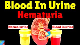 Blood In Urine Hematuria  Causes Symptoms Diagnosis Treatment amp Prevention [upl. by Ahsitak]