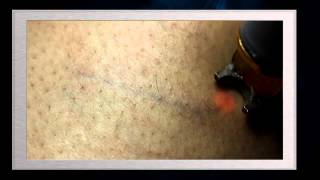 Tratamiento laser de varices de las piernas Nd YAG 1064 nm laser system [upl. by Marks]