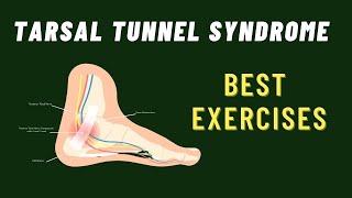 Tarsal Tunnel Syndrome 6 Best Exercises [upl. by Jose]