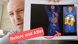 What does Lymphoma look like on a Pet Scan Before and After Chemo [upl. by Zinn]